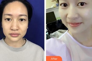 泉州億星醫(yī)療美容門診部葛海輝整形價格表附面部埋線提升案例展示