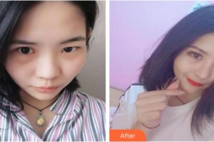 泉州歐菲醫(yī)療美容門診部王偉韜整形價格表附隆鼻案例展示