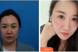 泉州歐菲醫(yī)療美容門診部韓飛整形價格表附埋線提升案例展示