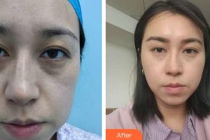 泉州歐菲醫(yī)療美容門診部林婷婷整形價格表附埋線提升案例展示