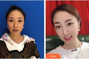 泉州歐菲醫(yī)療美容門診部劉先鋒整形價格表附多方面部埋線提升案例展示