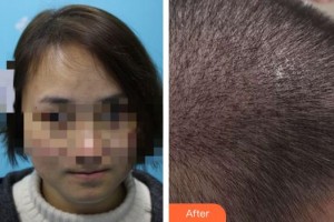 泉州歐菲醫(yī)療美容門診部夏瓊整形價格表附毛發(fā)移植案例展示