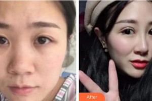 泉州海峽醫(yī)療美容醫(yī)院陳麗平整形價格表附綜合美眼案例展示