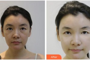 泉州海峽醫(yī)療美容醫(yī)院王秀萍整形價格表附熱瑪吉（面+頸）-面部緊致案例展示