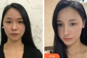 泉州美萊華美醫(yī)療美容門診部楊和強整形價格表附鼻部手術案例展示