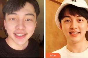 泉州海峽醫(yī)療美容醫(yī)院王嬌嬌整形價格表附瓷貼面案例展示