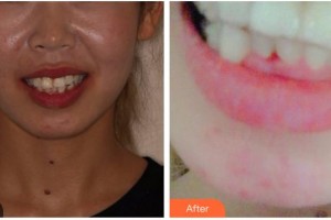 泉州泉興口腔門診部蔡娜芬整形價格表附牙齒隱形矯正案例展示