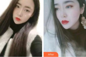 泉州泉興口腔門診部范桂菊整形價格表附金屬托槽矯正案例展示