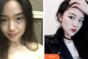 泉州西華醫(yī)療美容醫(yī)院陳世明整形價格表附面部年輕化案例展示