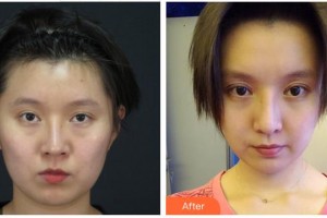 泉州維密醫(yī)療美容門診部夏昂整形價格表附重瞼修復+開內眥案例展示