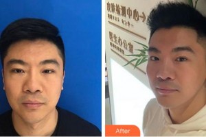 泉州維密醫(yī)療美容門診部林楦整形價格表附埋線提升案例展示