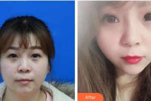 泉州美萊華美醫(yī)療美容門診部鐘豪整形價格表附埋線提升案例展示