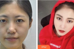 泉州美萊華美醫(yī)療美容門診部宋凡偉整形價格表附眼部綜合案例展示