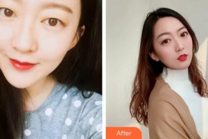 泉州海峽醫(yī)療美容醫(yī)院盧燕云整形價格表附眼部綜合案例展示