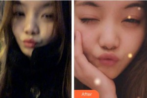 泉州泉興口腔門診部李家勝整形價格表附牙齒隱形矯正案例展示