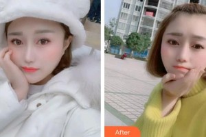 泉州泉興口腔門診部陳曉芳整形價格表附牙齒金屬矯正案例展示