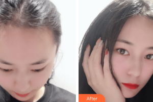 廣州雍禾植發(fā)門診部馬中林整形價格表附發(fā)際線種植案例展示