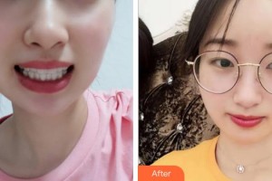 泉州泉興口腔門診部張春陽整形價格表附牙齒隱形矯正案例展示