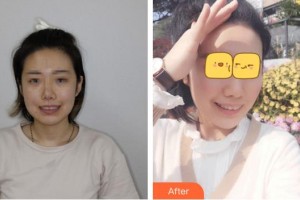 泉州泉興口腔門診部汪瑩整形價格表附牙齒隱形矯正案例展示