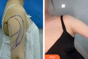 廣州法思脂肪移植醫(yī)學(xué)美容醫(yī)院胡榮軍整形價格表附手臂吸脂案例展示