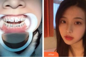 泉州貝臣口腔門診部鄧祺整形價格表附門縫妹變牙計案例展示