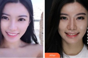 泉州維樂口腔門診部謝燕峰整形價格表附瓷貼面案例展示