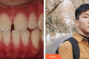 泉州維樂口腔門診部王燕燕整形價格表附金屬托槽矯正案例展示