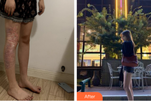 廣州國姿醫(yī)療美容整形醫(yī)院盧艷整形價格表附增生疤痕案例展示