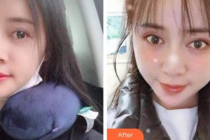 泉州貝臣口腔門診部于文英整形價格表附自鎖托槽矯正案例展示