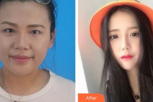 泉州愛爾眼科醫(yī)院金麗文整形價格表附眼部手術(shù)-萌系貓式電眼案例展示