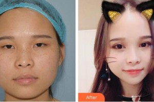 泉州愛爾眼科醫(yī)院許建斌整形價格表附雙眼皮案例展示