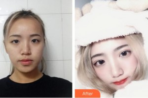 泉州愛爾眼科醫(yī)院吳松一整形價格表附切開雙眼皮案例展示