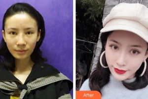 泉州愛爾眼科醫(yī)院李貴洲整形價格表附經(jīng)典切開雙眼皮案例展示