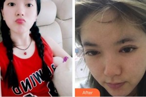 泉州愛爾眼科醫(yī)院洪英俊整形價格表附眼部綜合案例展示