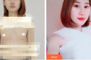 泉州星念醫(yī)療美容門診部施秀麗整形價格表附假體隆胸案例展示