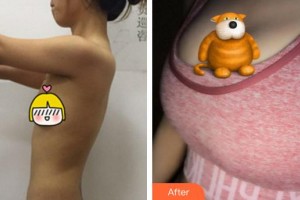 泉州脂管加醫(yī)療美容門診部林世達整形價格表附自體脂肪隆胸案例展示