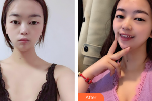 廣州解放軍第四五八醫(yī)院激光整形美容中心鄒吉平整形價格表附自體脂肪隆胸案例展示