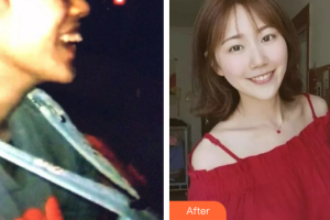 廣州壹加壹美容醫(yī)院蘇文新整形價格表附隱形托槽矯正案例展示