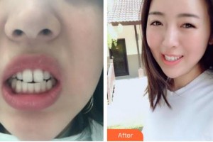 漳州衛(wèi)生職業(yè)學(xué)院附屬口腔醫(yī)院方雅君整形價格表附隱形矯正案例展示