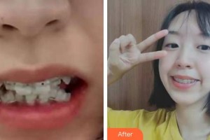 漳州佳美口腔門診部黃建欽整形價格表附牙齒矯正案例展示