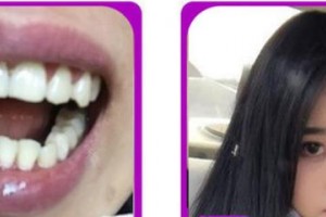 漳州佳美口腔門診部謝麗娟整形價格表附牙齒矯正案例展示