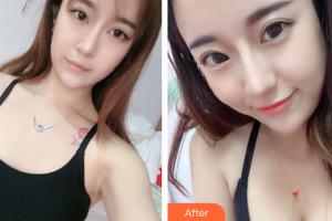 廣州伊麗莎白醫(yī)學(xué)美容門診部明皓整形價格表附自體脂肪隆胸案例展示