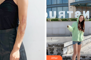 廣州中科美整形醫(yī)院徐思思整形價格表附手臂疤痕案例展示