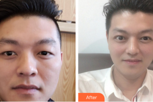 廣州博研醫(yī)療美容門診部吳良才整形價格表附切開雙眼皮案例展示