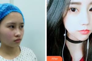 廣州柏美醫(yī)學(xué)美容醫(yī)院Jackyxu整形價格表附埋線提升案例展示