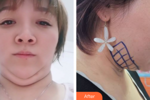 廣州壹加壹美容醫(yī)院王大勇整形價格表附面部輪廓案例展示