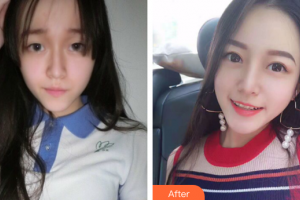 廣州藝美醫(yī)療美容門診部張濤整形價格表附雙眼皮0案例展示