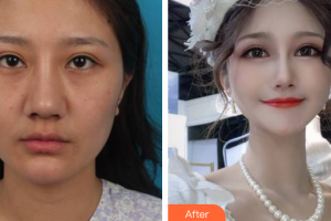 廣州柏美醫(yī)學(xué)美容醫(yī)院劉志剛整形價格表附下頜角+顴骨+下頦案例展示