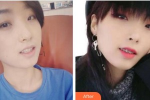 漳州佳美口腔門診部陳雋整形價格表附超聲波洗牙案例展示