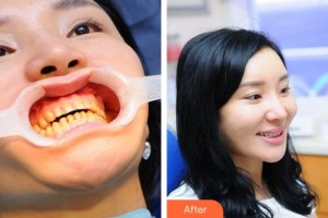 漳州佳美口腔門診部周東江整形價格表附冷光美白案例展示